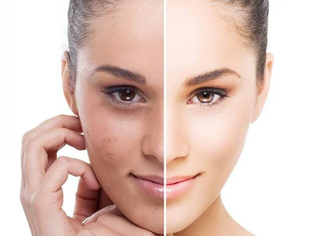 Técnicas que te ayudarán a eliminar las marcas del acné y otras cicatrices.